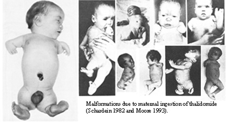 Click image for larger version

Name:	Thalidomide_effects.jpg
Views:	1
Size:	43.9 КБ
ID:	3821278